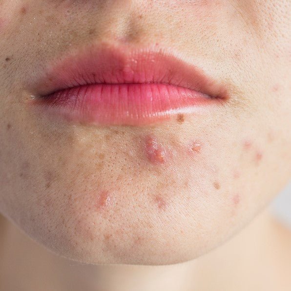 The Essential Guide for you to Cleansing Oily and Acne-Prone Skin