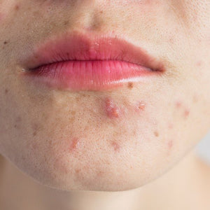 The Essential Guide for you to Cleansing Oily and Acne-Prone Skin